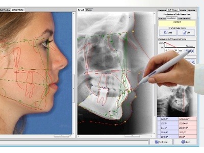 Cephalometri - Tandlæge