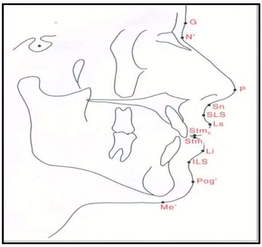 Cephalometri målepunkter i blødt væv