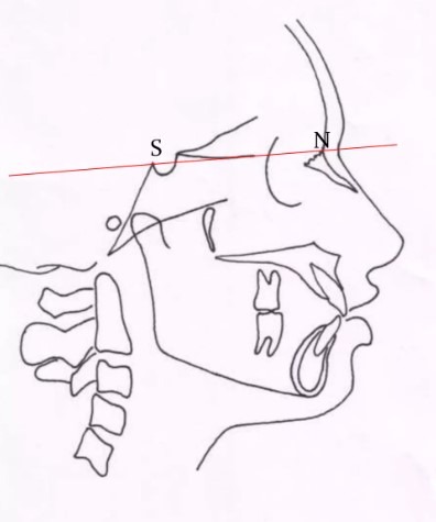 Sella-Nasion plan