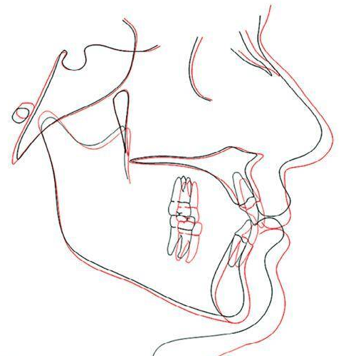 Cephalometri : Sammenligning ansigtsprofil som 17 årig og 61 årig. Gennemsnit mænd og kvinder. 