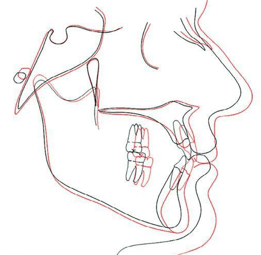 Cephalometri : Sammenligning ansigtsprofil som 17 årig og 61 årig. Gennemsnit mænd. 