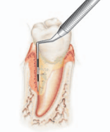 Måling af tandkødslommer (pocher) med pochemåler. Til venstre poche med fæstetab som følge af parodontitis.