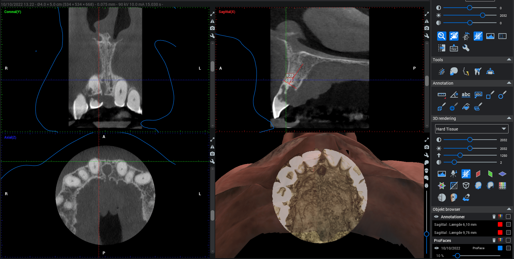 CBCT scanning af fortand, hvor der skal planlægges indsættelse af implantat. © Tandlæge Jakob Kihl | Lyngby