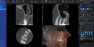 Interesse området afbildes som en cylinder, hvor mål (her til indsættelse af implantat) kan indsættes præcist i 3D. © Tandlæge Jakob Kihl