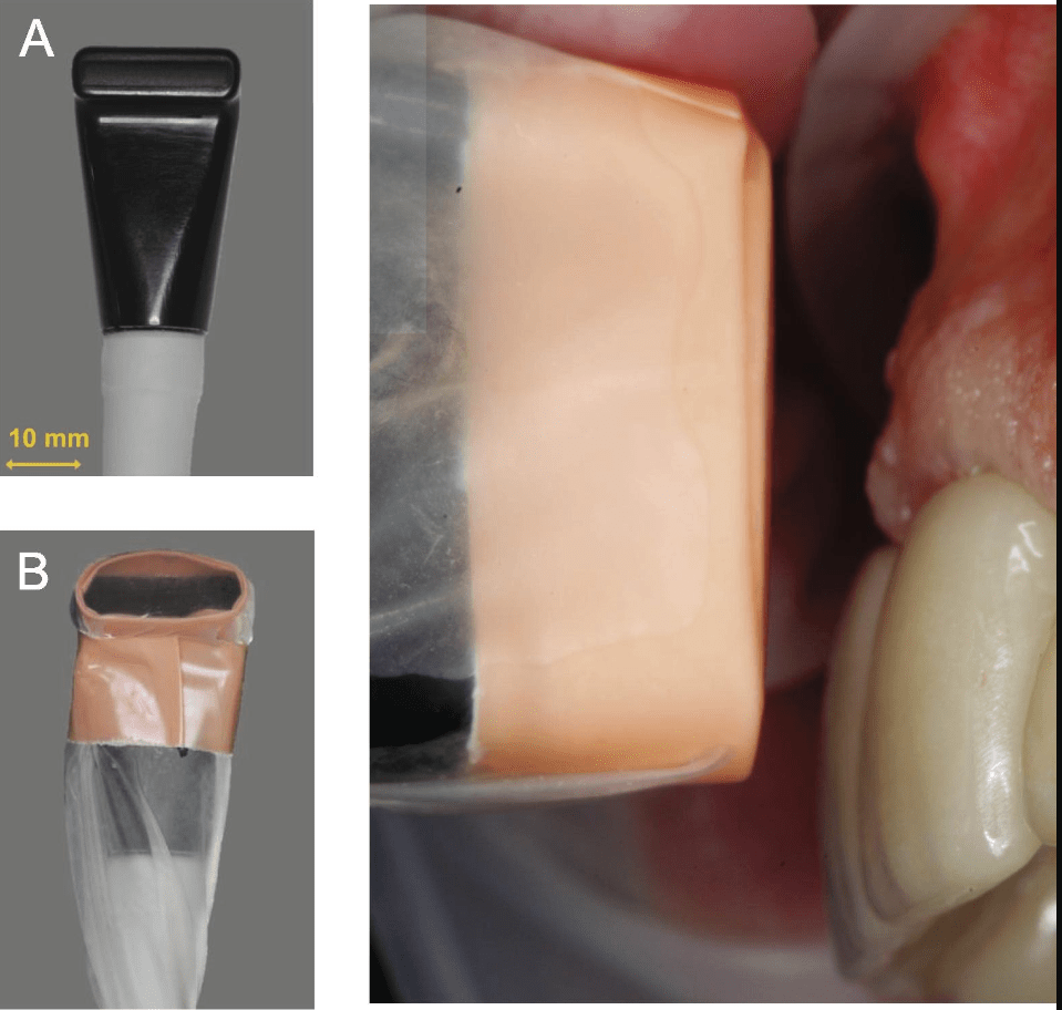Ultralyd scanning (US) af tandkød