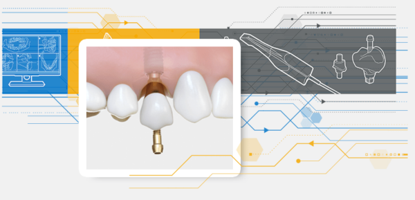 DentsPly Sirona ASTRA Implant Azento System