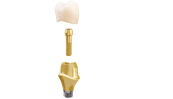 ASTRA Atlantis permanent (gold-shaded titanium) Abutment. Abutment er special fræset fra en blok med titanium (Ti 6Al-4V) ud fra opmålingen i 3D. Tandlæge Jakob Kihl