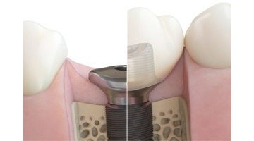 ASTRA Azento guided implant. Illustration viser udformning af healing abutment (venstre) og udformning af permanent abutment + krone (højre). Tandlæe Jakob Kihl