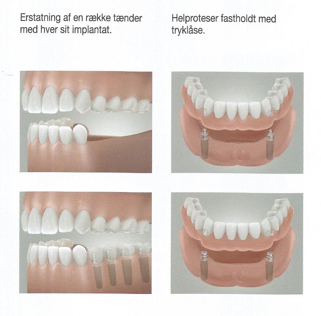 Eksempler på implantat løsninger Tandlæge Jakob Kihl