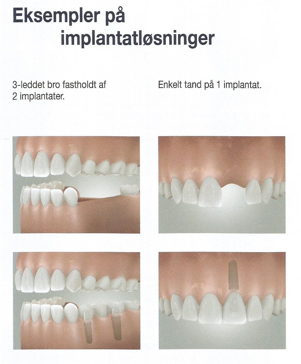 Eksempler på implantat løsninger ved tab af en enkelt fortand eller tab af 3 kindtænder. Tandlæge Jakob Kihl