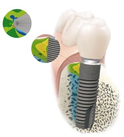 Illustration af belastningsoverførslen til knogle fra den øverste del af implantatet (implantatets hals), hvor implantat hals er udformet med småriller (microthreads). Smårillerne fordeler ved belastning af implantat belastningen af knoglevævet og vil biomekanisk kunne stimulere knogle dannelse. I det viste eksempel ASTRA MicroThread®. Tandlæge Jakob Kihl